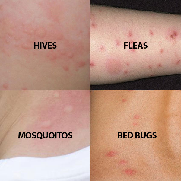 bed bug bites what do they look like - BC Bed Bug Expert